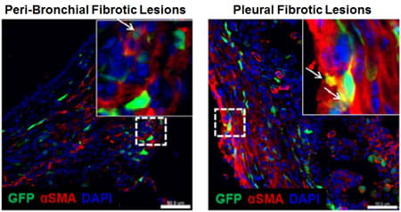 Figure 1: TGFα overexpressing mice show invasion and accumulation of fibrocytes (Green) along with resident stromal cells of dense fibrotic lesions in the lung.